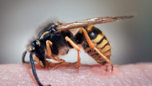 wasp-sting-treatment